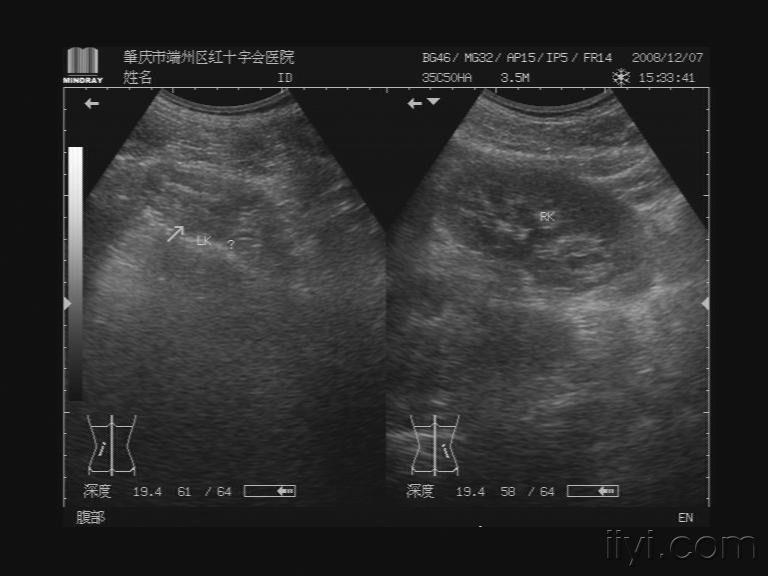 肾缺如?肾萎缩?