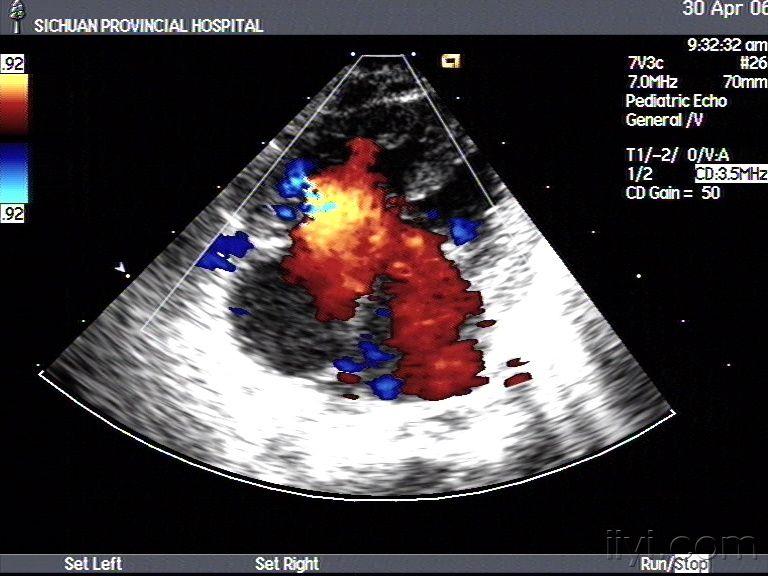 完全性心内膜垫缺损超声图谱
