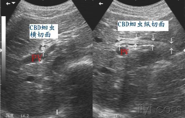 胆总管蛔虫 - 超声医学讨论版 - 爱爱医医学论坛 - 医