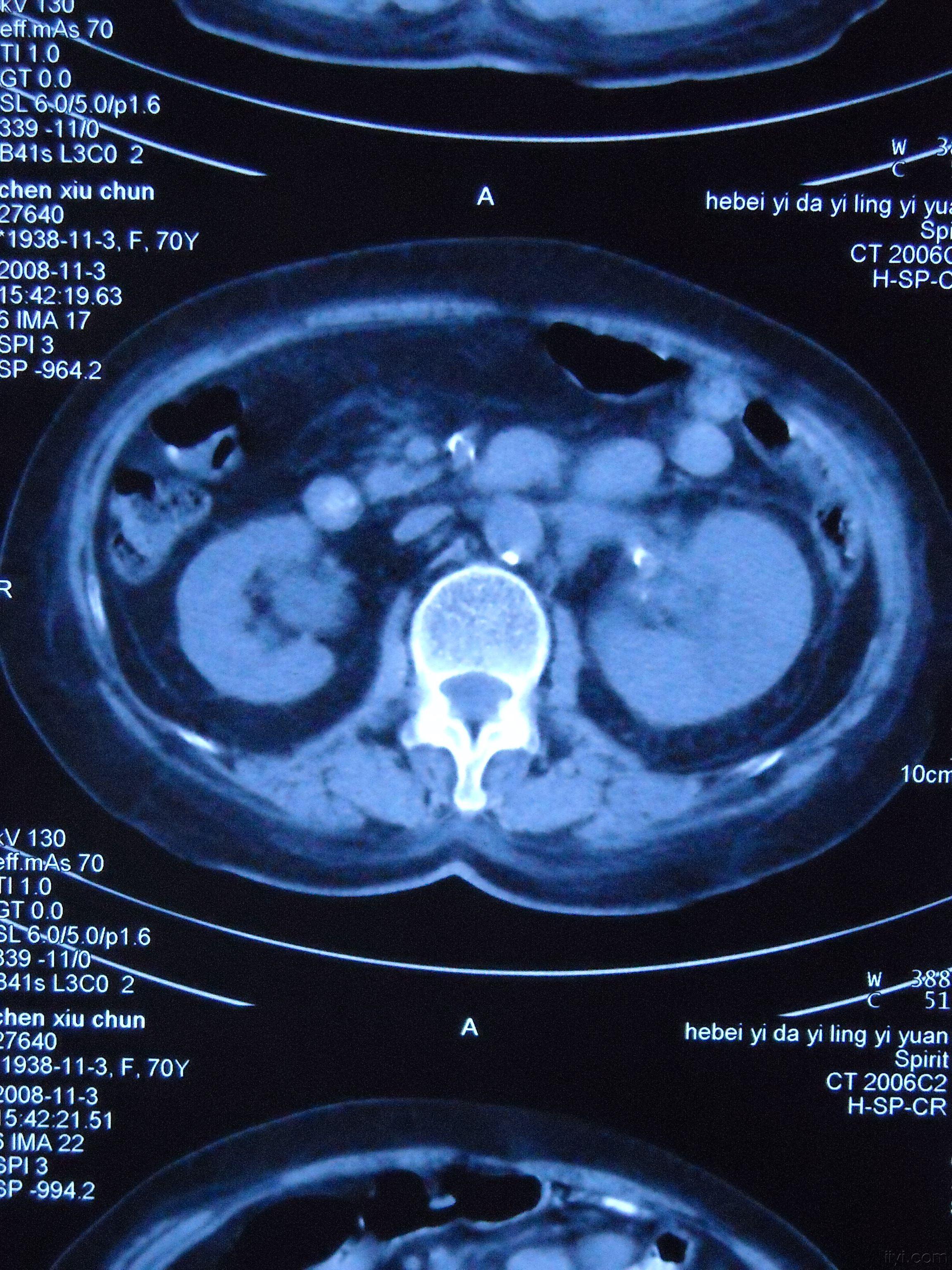 请教肾脏ct - 肾脏内科讨论版 - 爱爱医医学论坛-爱爱