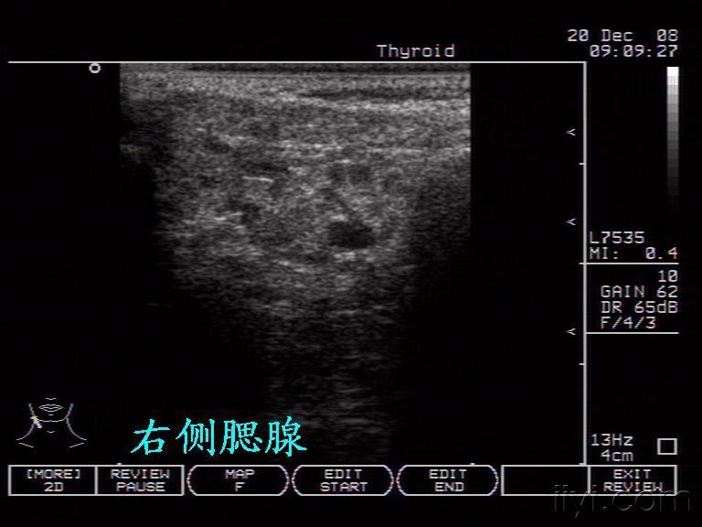 腮腺炎(淋巴性 超声医学讨论版 爱爱医医学论坛 爱爱医医学网