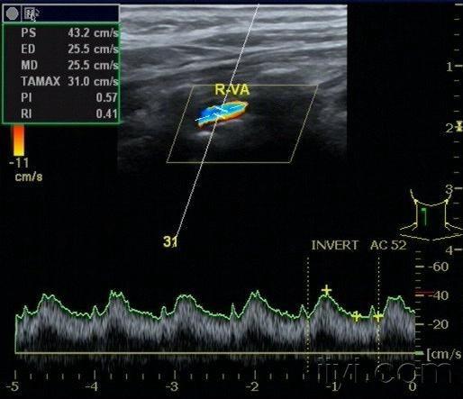 帮忙看看这个血管(双侧椎动脉频谱呈"小慢波"?)谢谢
