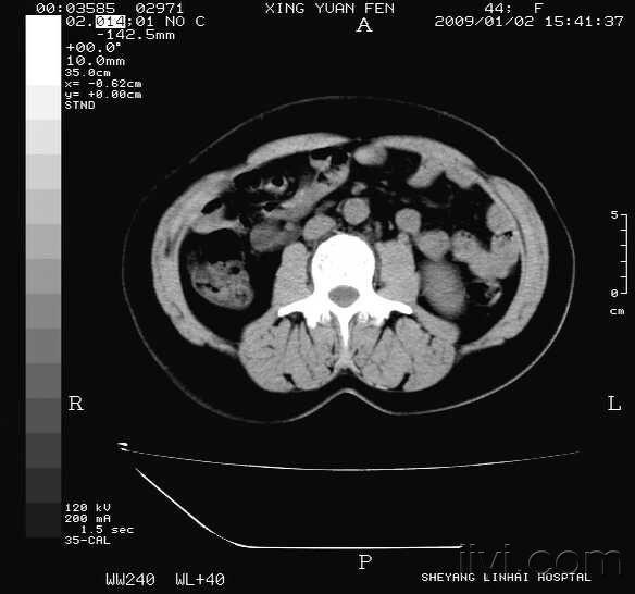 双肾输尿管ct请各位讨论!