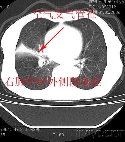 或叶间胸膜增厚? - 医学影像学讨论版