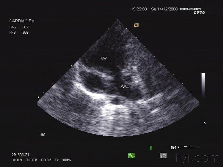 图片分享:超声-新生儿先心病-完全性大动脉转位