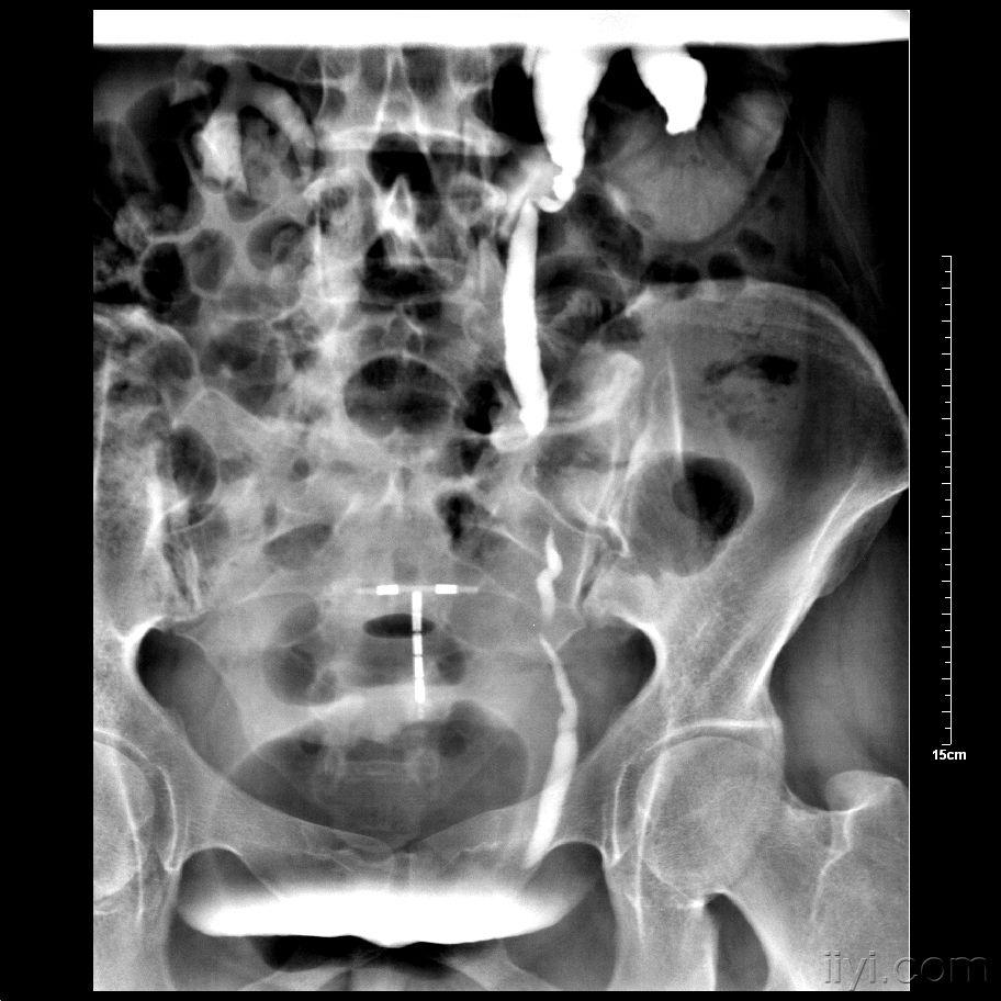 经典 逆行尿路造影并发症 请同道们讨论