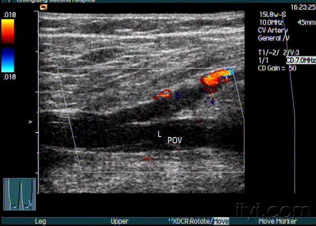剖腹产后左下肢深静脉血栓形成又1例 超声医学讨论版 爱爱医医学