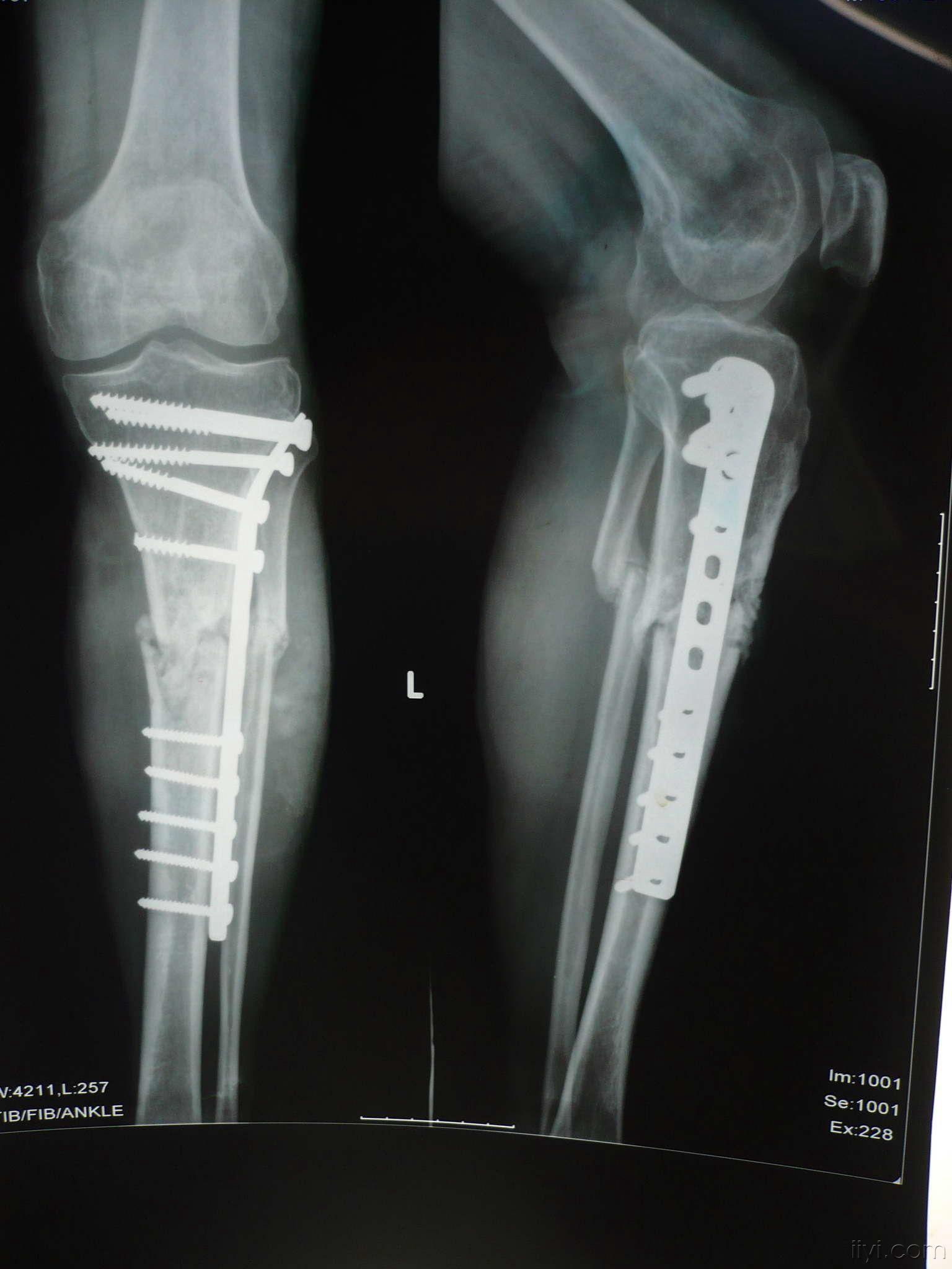 胫骨骨折术后5个月未见明显骨痂