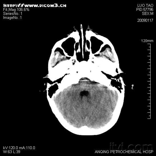 两例外伤后右顶叶低密度灶求助