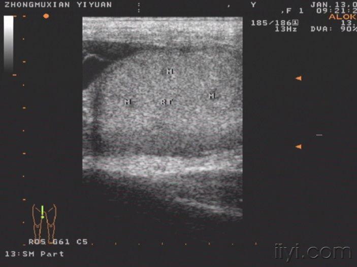 【欣赏】附睾结核侵犯睾丸一例!(手术已经证实)