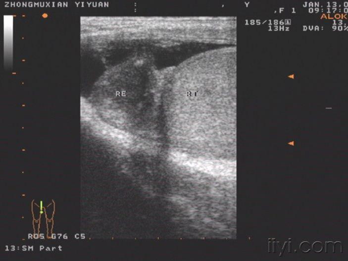 【欣赏】附睾结核侵犯睾丸一例!(手术已经证实)