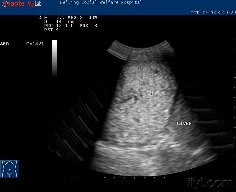小儿的肝母细胞瘤 超声医学讨论版 爱爱医医学论坛 爱爱医医学