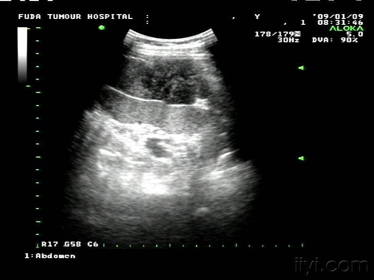 腹腔脾脏外侧囊实性肿物 超声医学讨论版 爱爱医医学论坛 爱爱