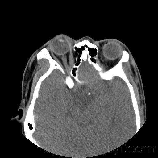 22:23:07患者,男,35岁,外伤半小时来我院查ct考虑双侧眼眶内侧壁骨折