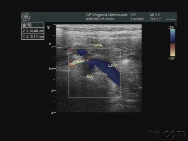 胡桃夹综合征 - 超声医学讨论版 - 爱爱医医学论坛
