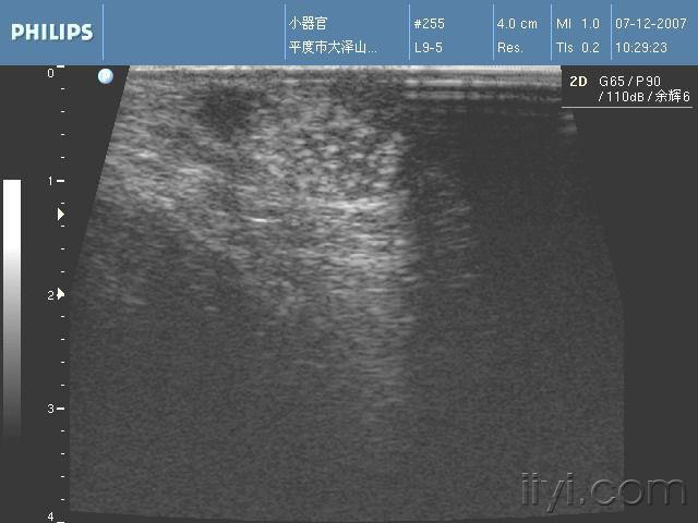 12岁睾丸微石症