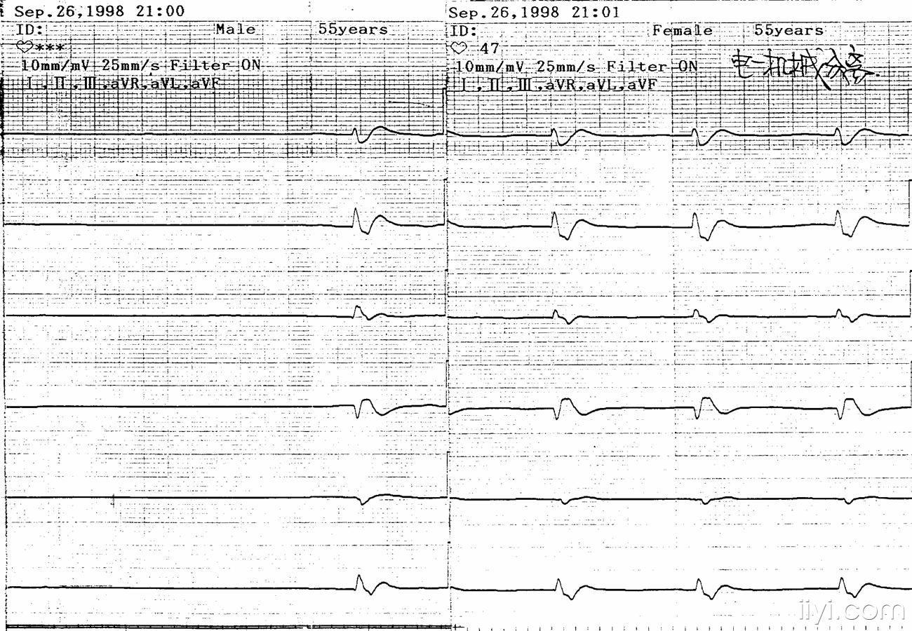 心电机械分离的心电图