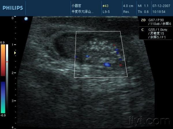 12岁睾丸微石症