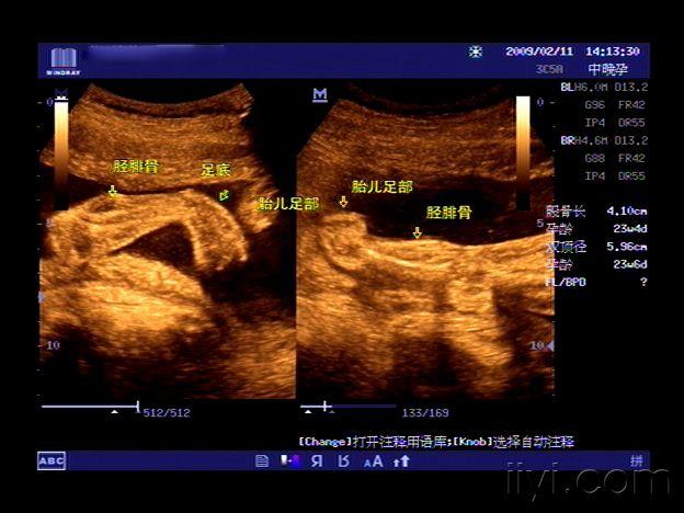 中孕胎儿单侧足内翻 - 超声医学讨论版 - 爱爱医医学