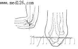 髋关节中心脱位和陈旧性髋关节后脱位等;也可用于胫骨结节牵引过久