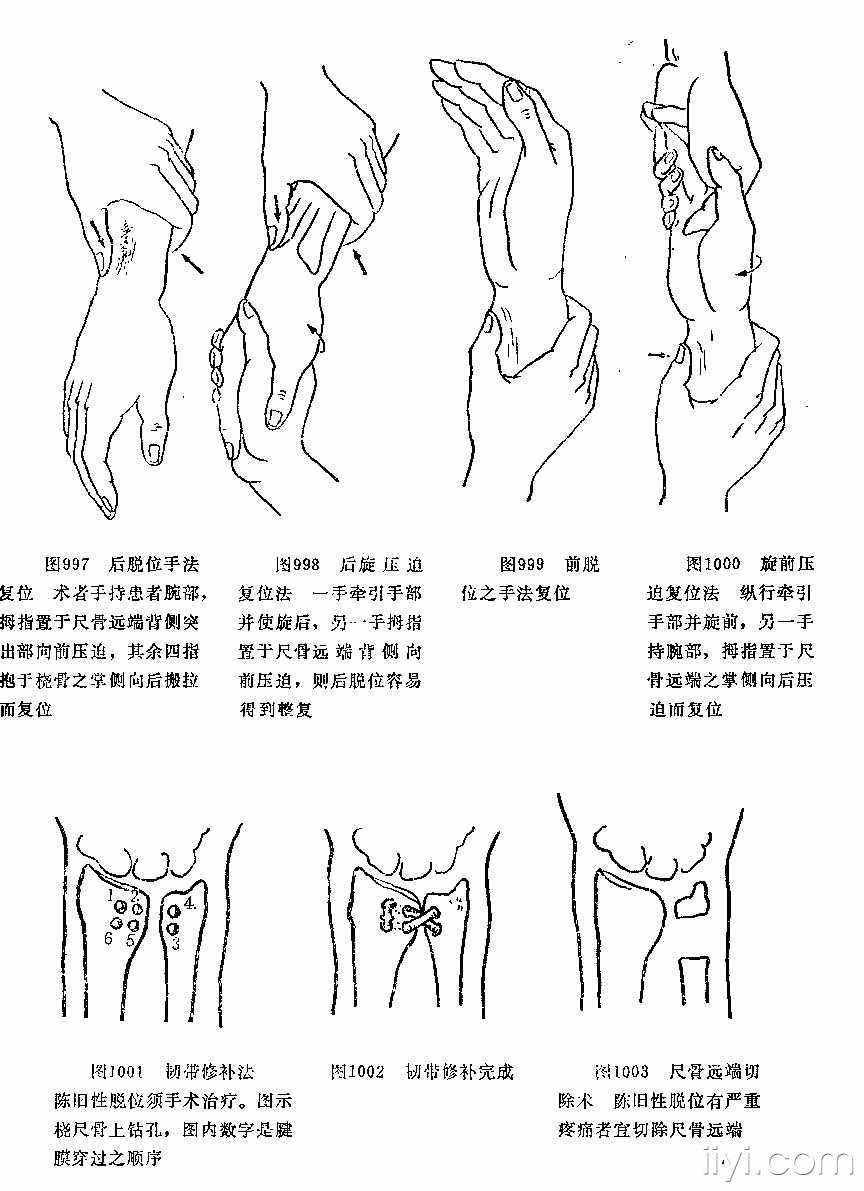 这个尺骨头脱位怎么处理