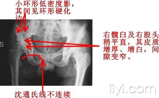 [分享,讨论]外伤后髋关节病变