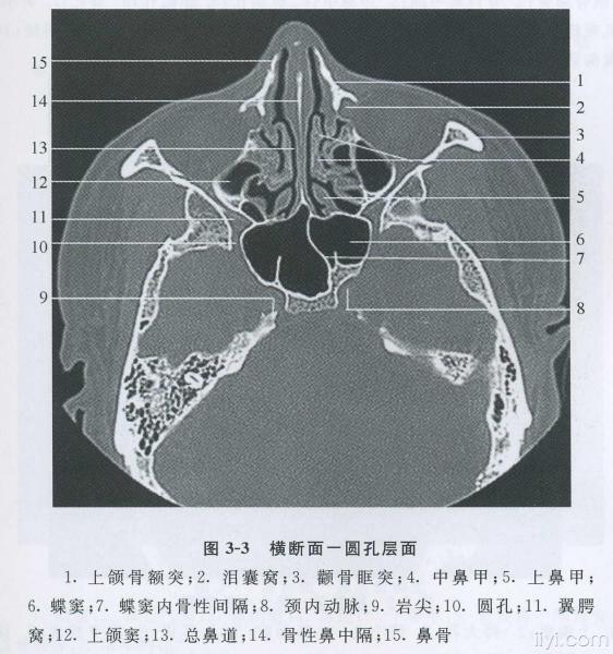 教科书式的鼻骨骨折!dr ct!