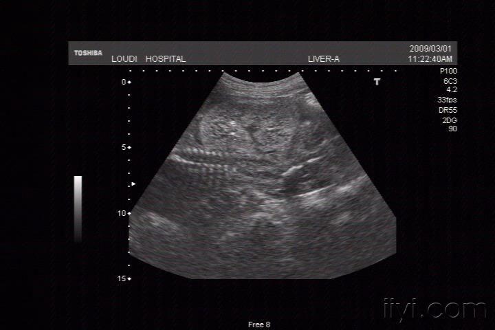 胎儿成人型多囊肾 超声医学讨论版 爱爱医医学论坛 爱爱医医学
