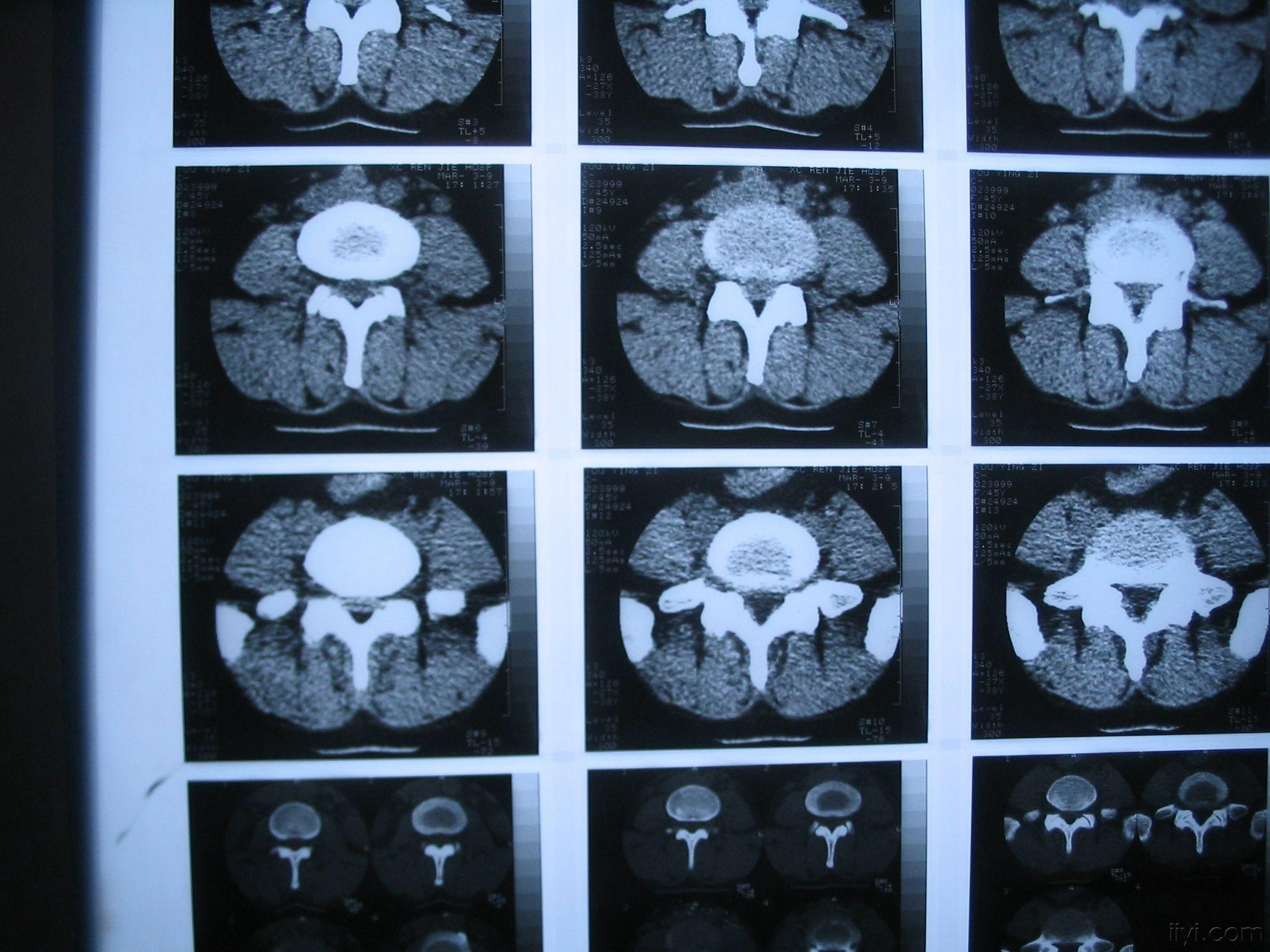 请教我读张腰椎ct片 - 医学影像学讨论版 - 爱爱医医学论坛 - 爱爱医