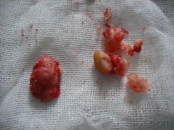 中指指骨骨软骨瘤的图片