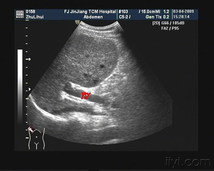 彩超:左肝内叶可见多个大小不等的囊状暗区,可见互通,cdfi可见丰富