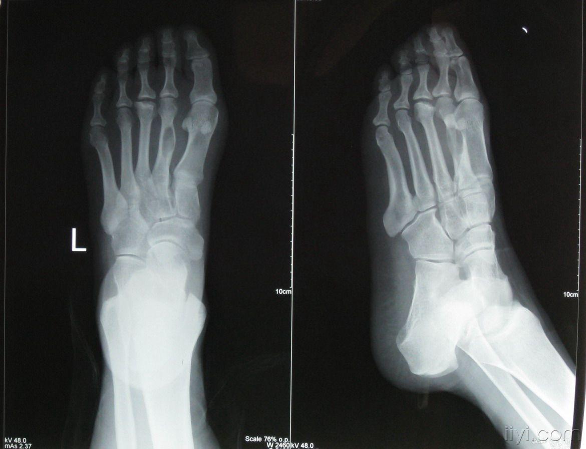 初步诊断:左足第二跖骨骨囊肿.