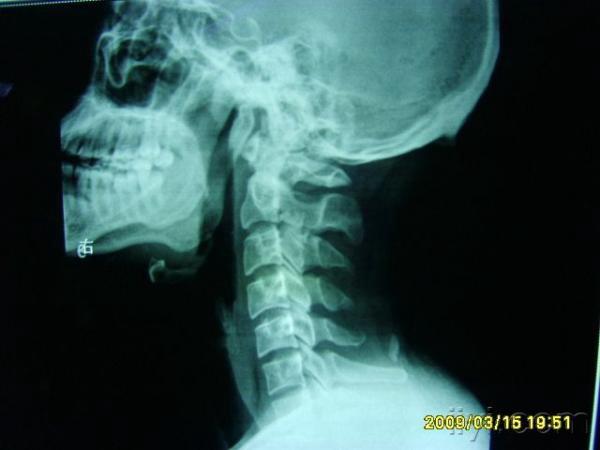 16年顽固头痛,天天痛,刚拍了颈椎核磁和颈椎x光片(cr)