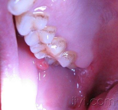 口腔右面牙龈附近黏膜长了个突起物,上有脓点,求助,内