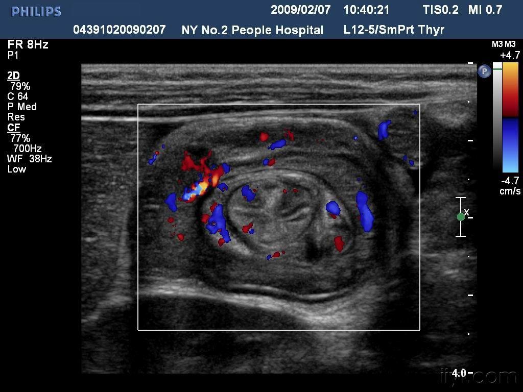 【贴图】肠套叠 - 超声医学讨论版 - 爱爱医医学论坛