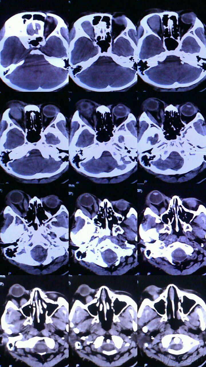 眼ct讨论,随访病例