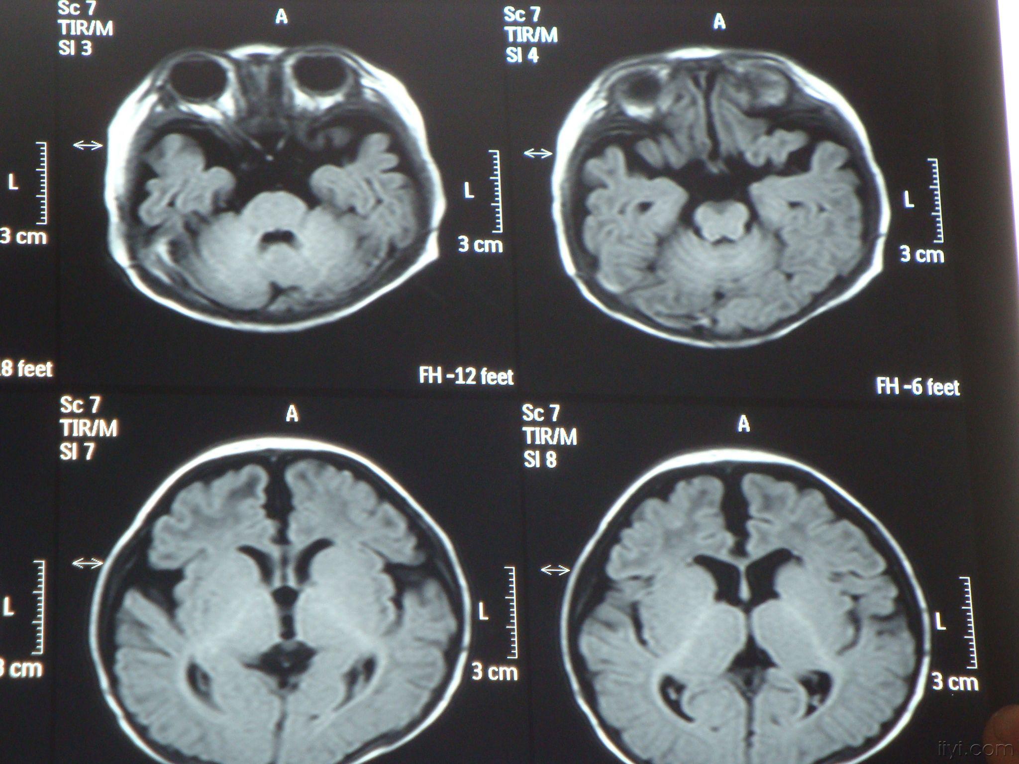 出生两个月小儿脑萎缩
