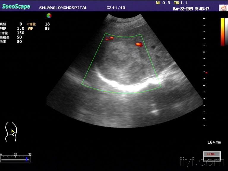 经典超声图片欣赏:原发性肝ca - 超声医学讨论版 - 医