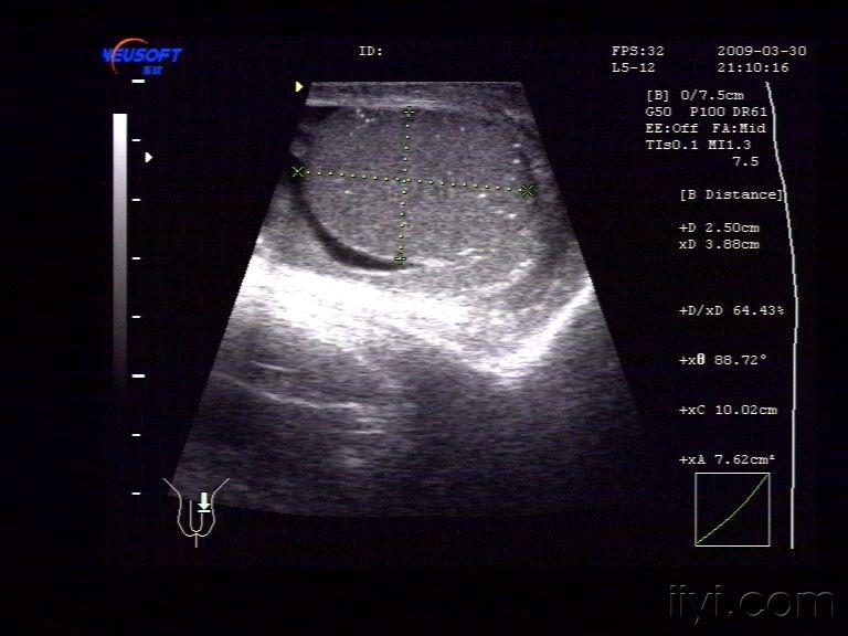 双侧睾丸微石症伴左侧睾丸炎(较典型,一起分享)
