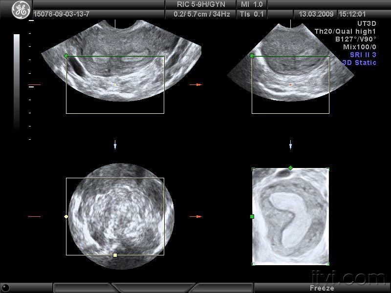 双子宫,纵隔子宫,以及双角子宫 的图片 - 超声医学版