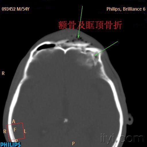 眼,鼻,上颌窦等的骨折,要慢慢的,小心的看喔