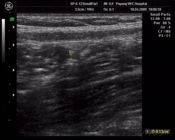 肿大淋巴结 回盲口 回盲部探及一长管状回声,经长时间观察无