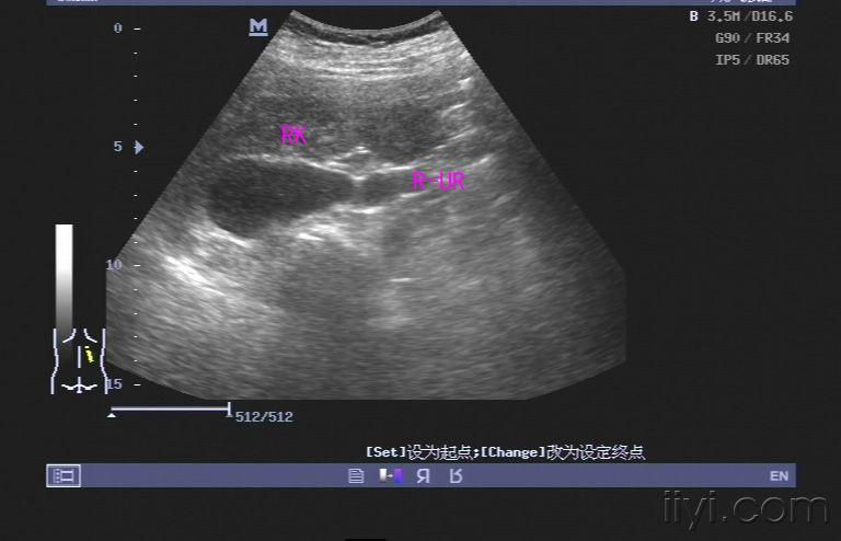 超声诊断重复肾