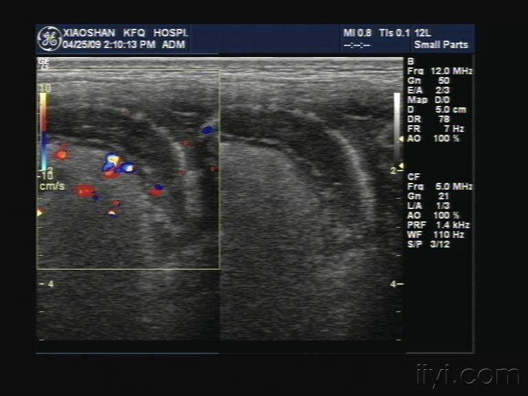 欣赏一个典型的阑尾炎. - 超声医学讨论版 - 爱爱医