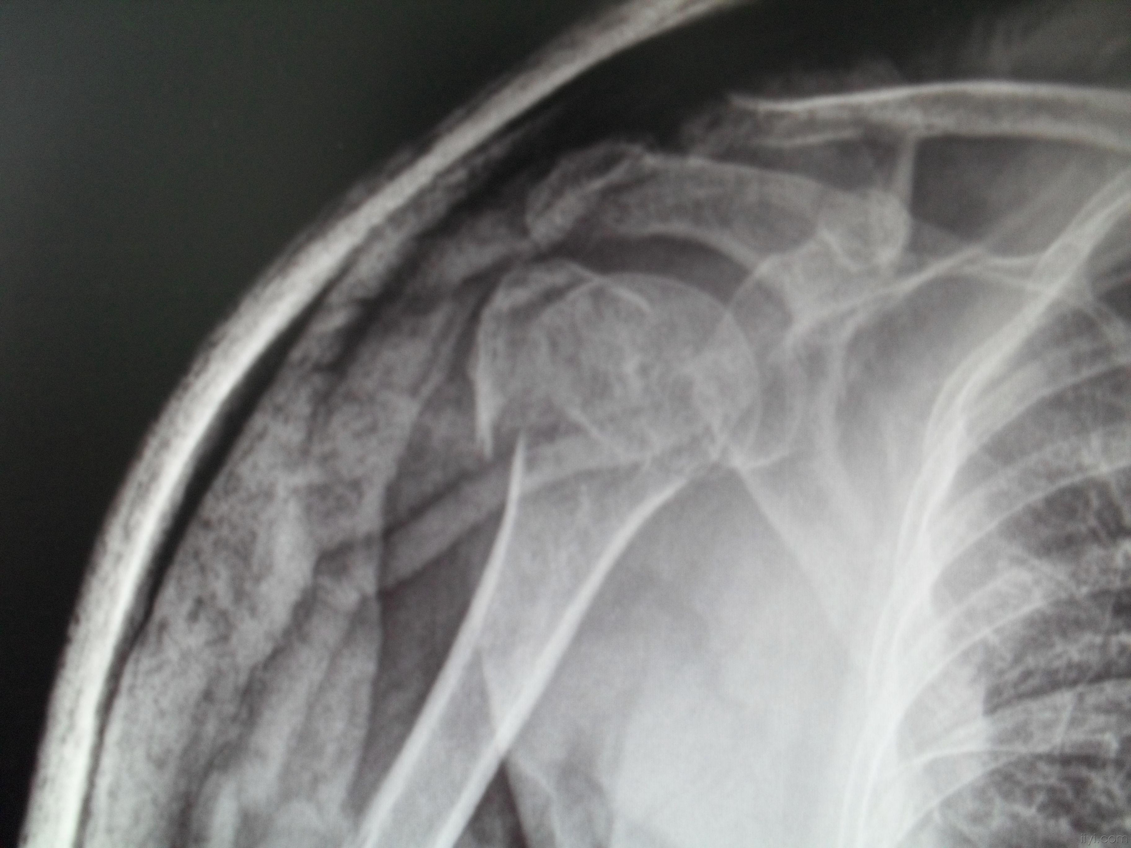 肱骨大结节骨折的治疗-图库-五毛网