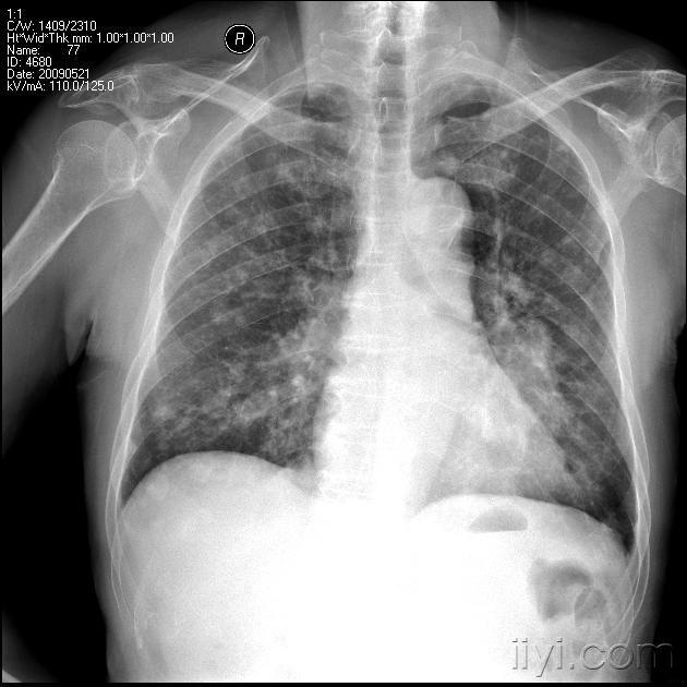一张肺部的平片