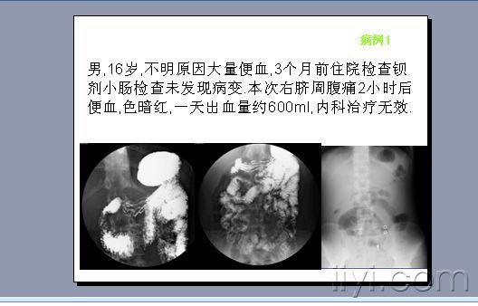 麦克尔憩室的影像学诊断