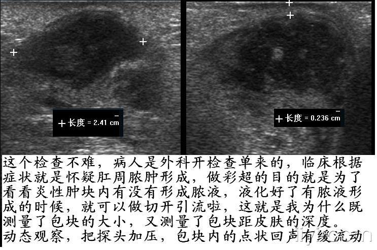 一天内看了两个肛周脓肿 - 超声医学讨论版 - 爱爱医