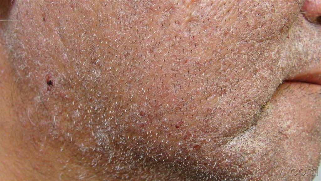  银屑病 +-+皮肤及性传播疾病讨论版