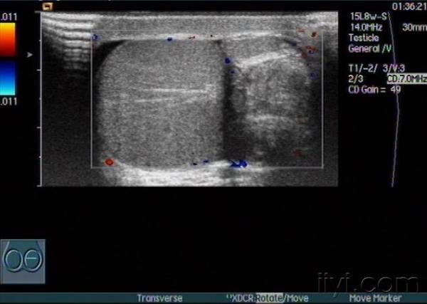 睾丸扭转及术后随访声像图 - 超声医学讨论版 - 爱爱